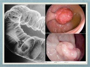 Diagnóstico por radiología Pólipos en colon